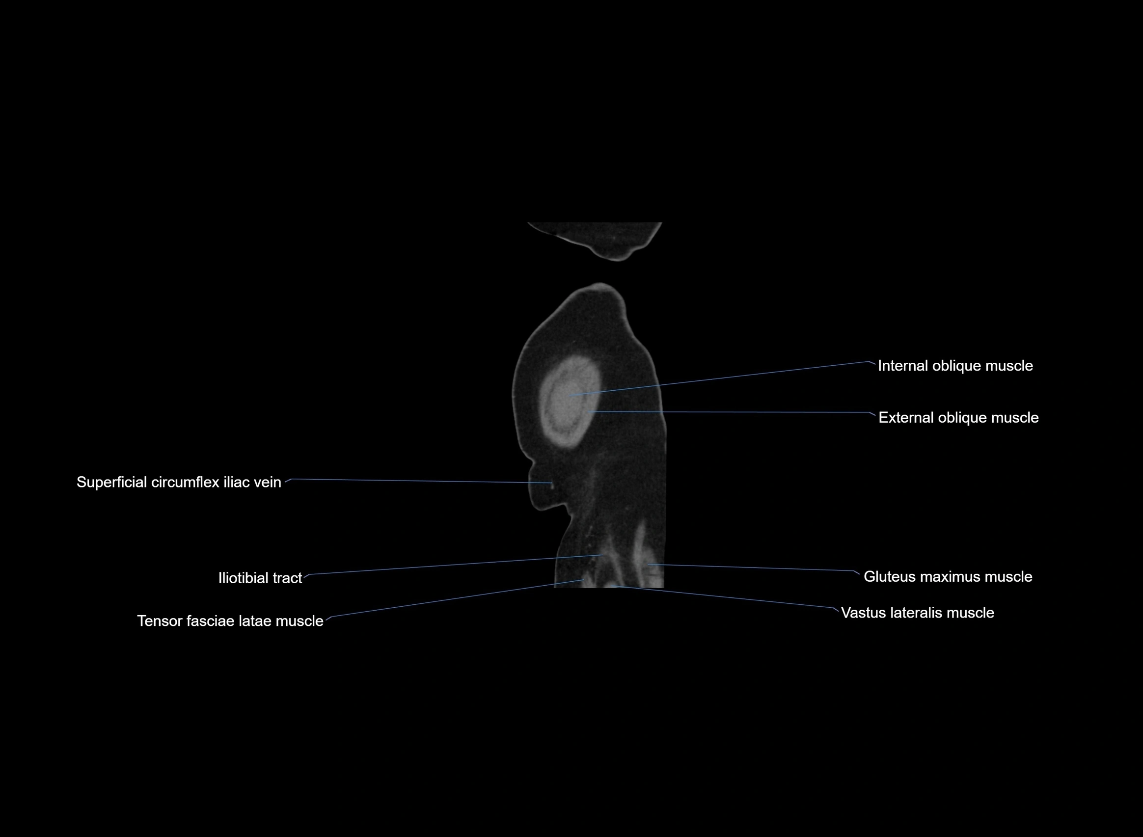 CT Abdomen sagittal cross sectional anatomy labelled radiology image -00004.webp